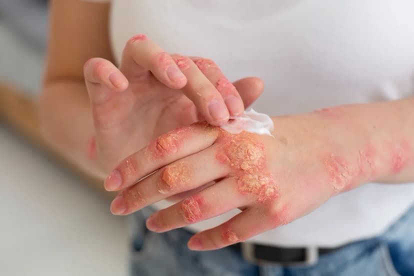 Fungal, Bacterial & Viral Skin Infections